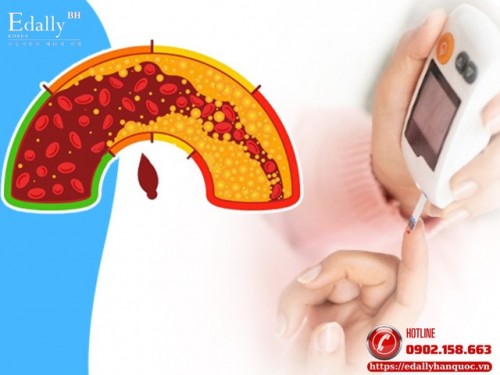 Cách Giảm Mỡ Nội Mô Cho Tế Bào Người Bệnh Tiểu Đường