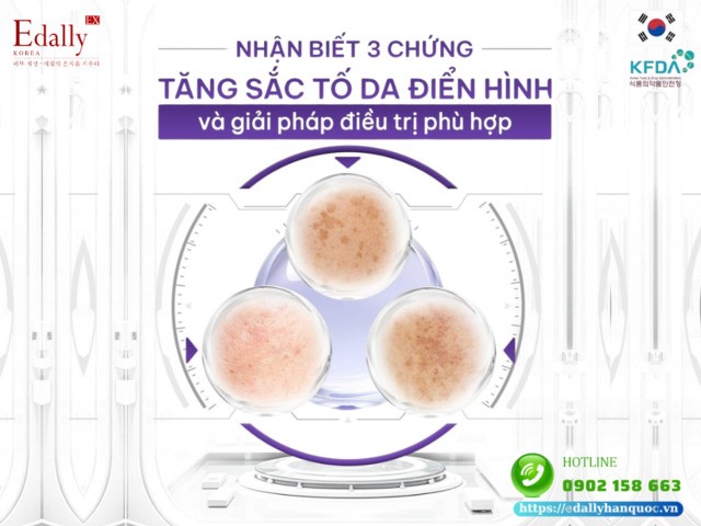 Cách nhận biết 3 chứng tăng sắc tố da điển hình và giải pháp điều trị phù hợp