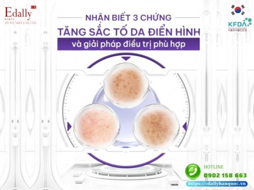 Nhận Biết 3 Chứng Tăng Sắc Tố Da Điển Hình Và Giải Pháp Điều Trị Phù Hợp