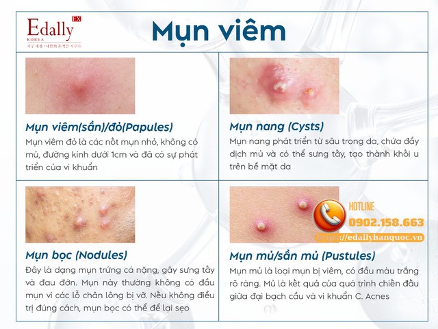 Cách nhận biết các loại mụn viêm