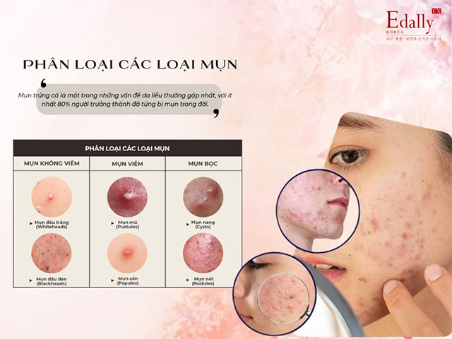 Cách nhận biết các loại mụn