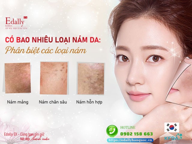 Cách nhận biết 3 loại nám da thường gặp nhất