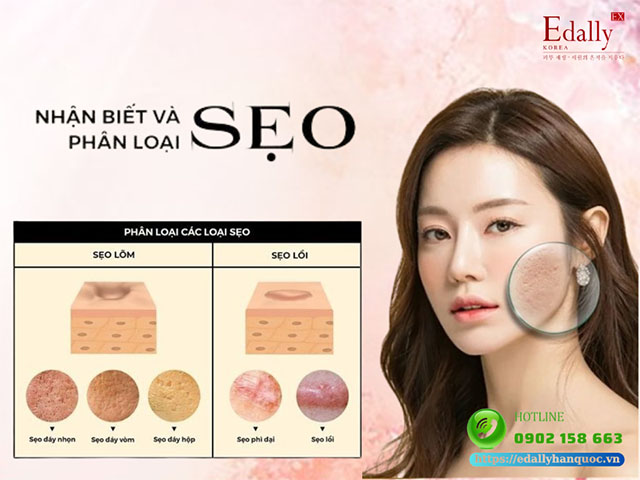 Cách nhận biết các thể loại sẹo thường gạp và phương pháp điều trị hiệu quả, an toàn