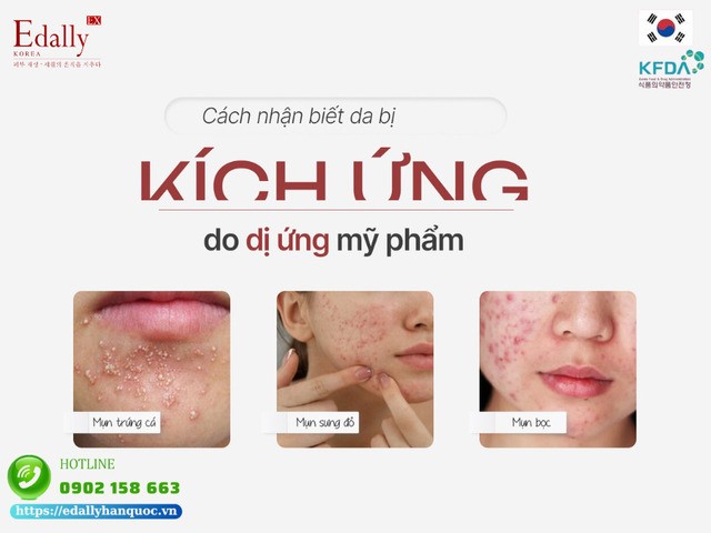 Cách nhận biết da bị kích ứng với mỹ phẩm