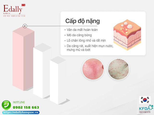 Dấu hiệu nhận biết da nhiễm corticoid ở cấp độ nặng