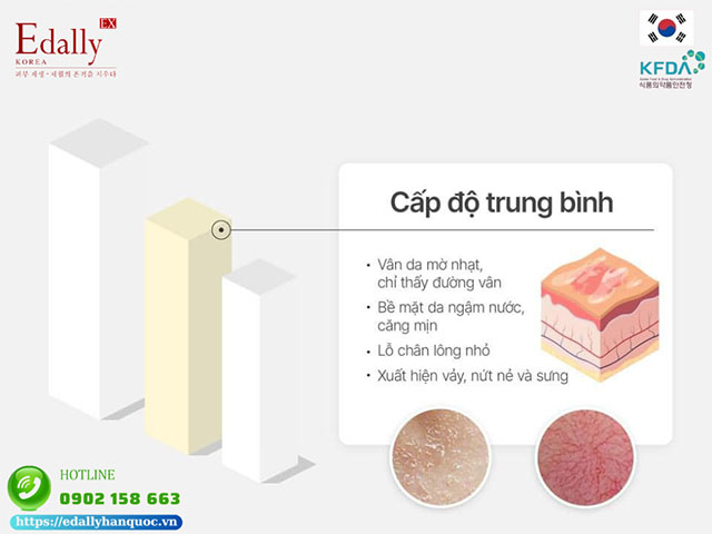 Dấu hiệu nhận biết da nhiễm corticoid ở cấp độ trung bình