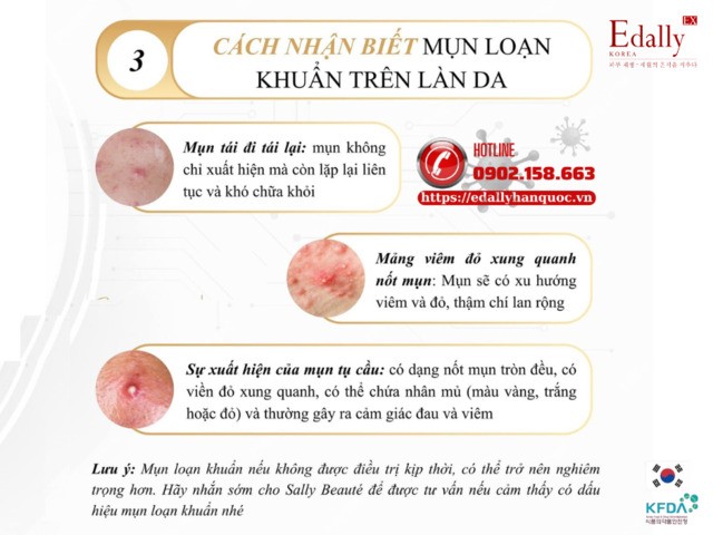 Cách nhận biết mụn loạn khuẩn trên làn da