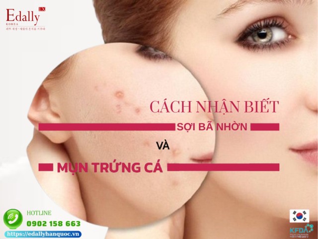 Cách nhận biết mụn trứng cá và sợi bã nhờn