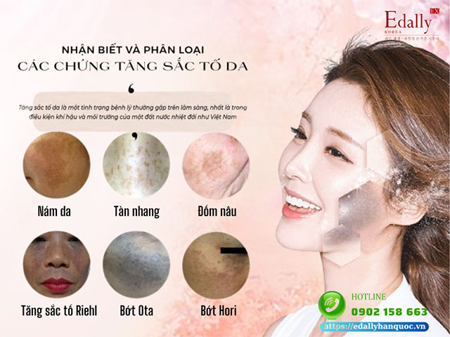 Cách nhận biết và phân loại các chứng tăng sắc tố da