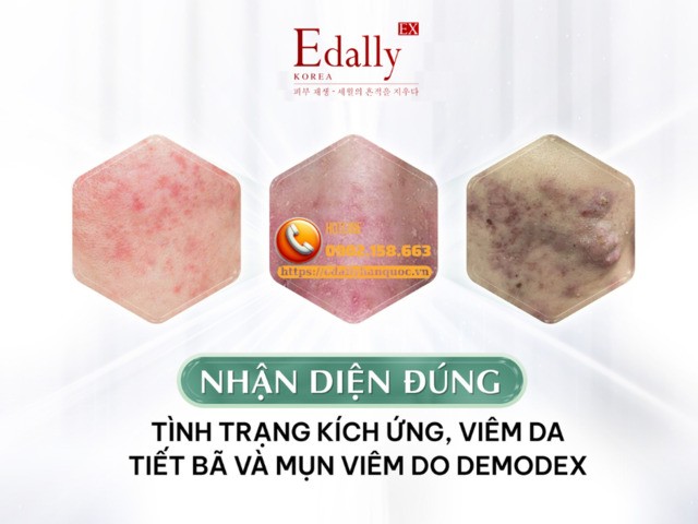 Bạn Đã Nhận Diện Đúng Kích Ứng, Viêm Da Tiết Bã Và Mụn Viêm Do Demodex Chưa? 