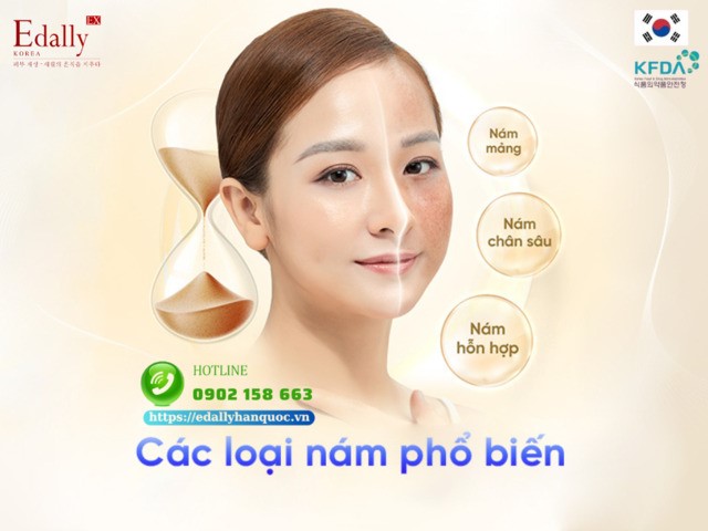 Cách nhận biết các loại nám và điều trị nám từ góc nhìn của chuyên gia