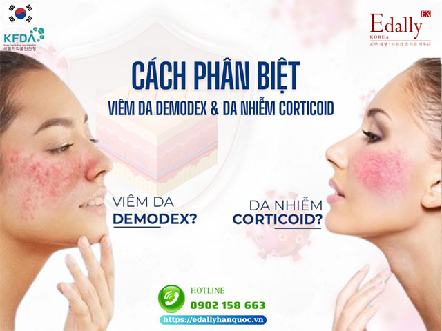 Làm sao để phân biệt các biểu hiện của viêm da Demodex và da bị nhiễm Corticoid