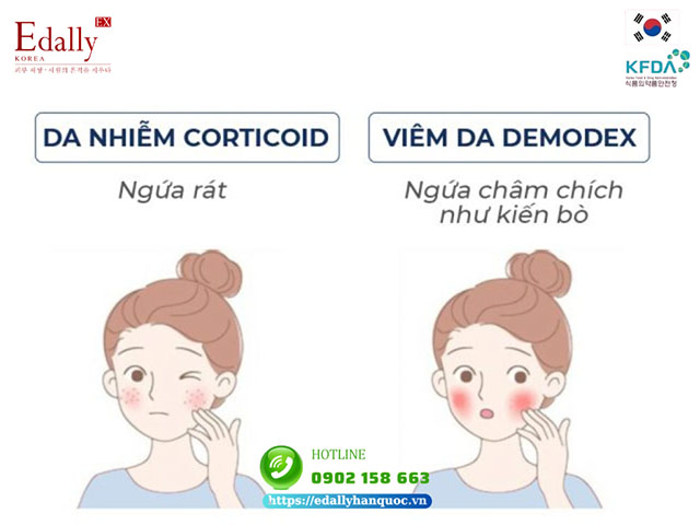 Cách phân biệt các dấu hiệu viêm da Demodex và da bị nhiễm Corticoid qua cảm giác ngứa trên da