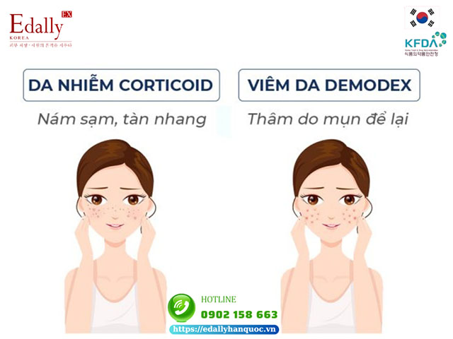 Cách phân biệt các dấu hiệu viêm da Demodex và da bị nhiễm Corticoid qua sắc tố da