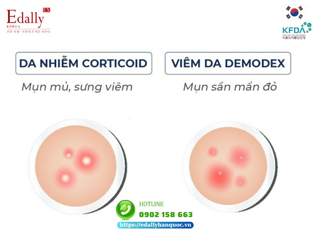 Cách phân biệt các dấu hiệu viêm da Demodex và da bị nhiễm Corticoid qua tình trạng mụn xuất hiện trên da