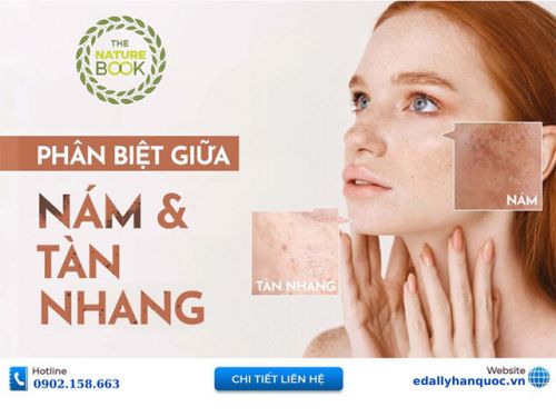 Cách Phân Biệt Nám Da Và Tàn Nhang Chuẩn Chuyên Gia