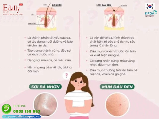 Cách phân biệt mụn đầu đen và sợi bã nhờn