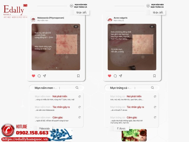 Cách phân biệt mụn nấm men (Malassezia) với mụn trứng cá