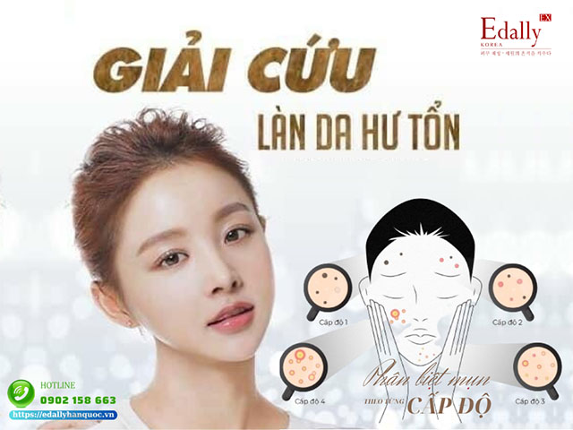 Cách Phân Biệt Mụn Theo Từng Cấp Độ