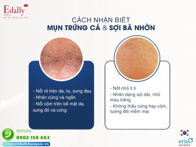 Cách phân biệt mụn trứng cá và sợi bã nhờn