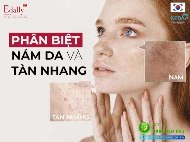 Cách phân biệt nám da và tàn nhang trên mặt