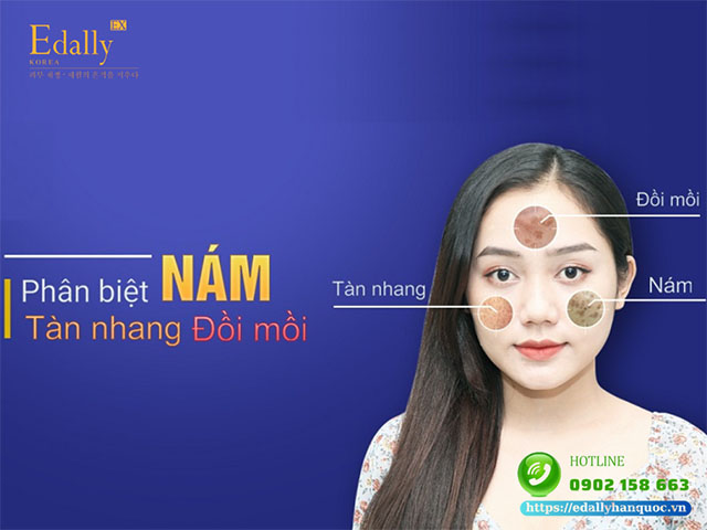 Cách phân biệt nám, tàn nhang, đồi mồi