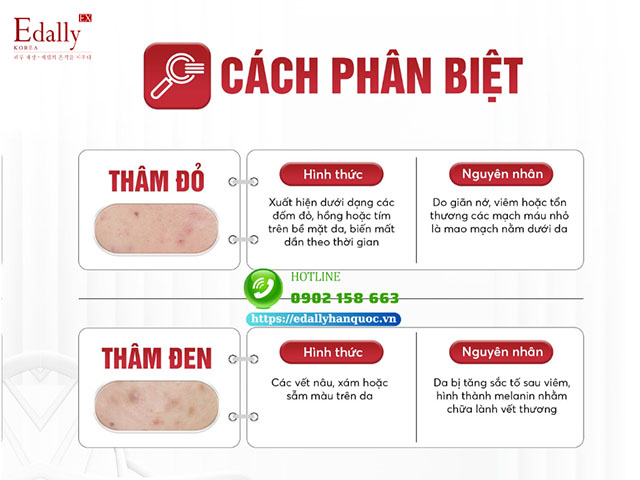 Cách phân biệt thâm đỏ và thâm đen sau mụn