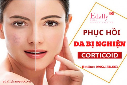 Cách Phục Hồi Da Nghiện Corticoid