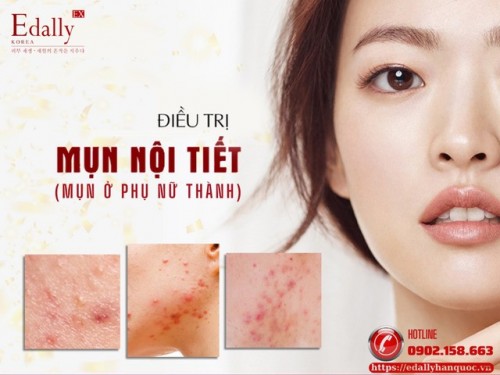 Quản Lý Mụn Ở Phụ Nữ Trưởng Thành