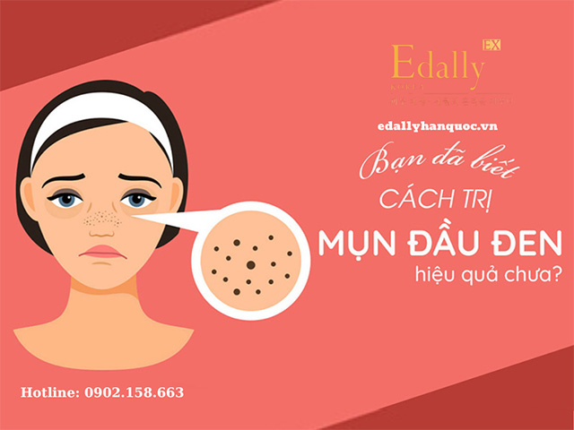 Skincare điều trị mụn đầu đen ở da dầu như thế nào?