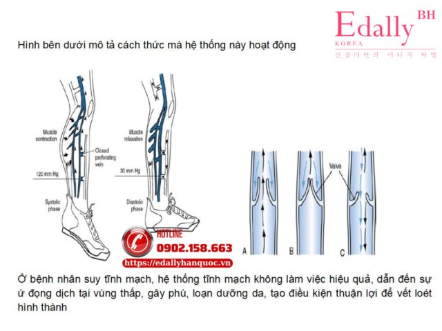 Quá trình gây bệnh loét tĩnh mạch