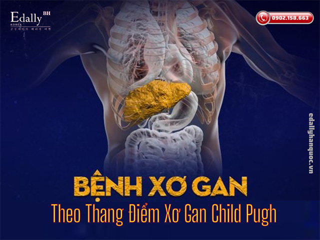 Cách tính mức độ xơ gan theo thang điểm xơ gan Child Pugh