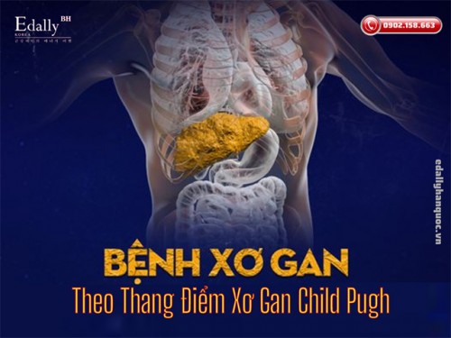 Cách Tính Mức Độ Xơ Gan Theo Thang Điểm Xơ Gan Child Pugh