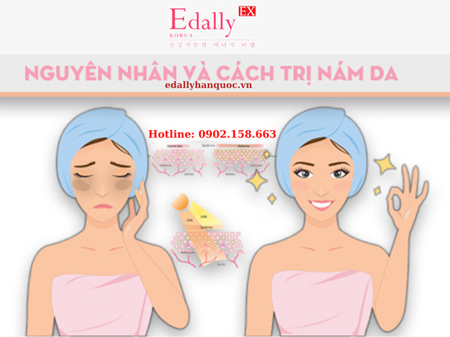 Trị bệnh nám da mặt cần lưu ý gì?