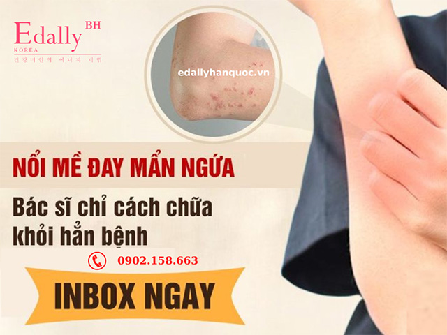 Cách trị nổi mẩn ngứa, mề đay từ dân gian