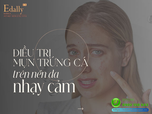 Cách trị mụn trứng cá trên nền da nhạy cảm hiệu quả tại nhà