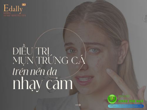 Cách Trị Mụn Trứng Cá Cho Da Nhạy Cảm