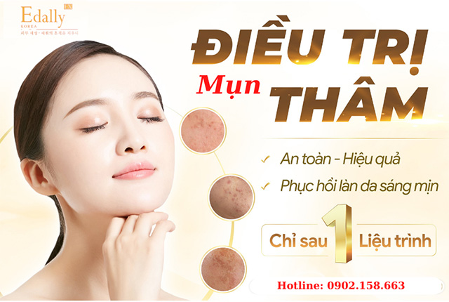 Cách trị mụn và thâm mụn trong vòng một liệu trình 6 tháng