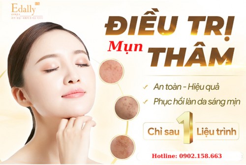 Cách Trị Mụn Và Thâm Mụn Trong Vòng 6 Tháng