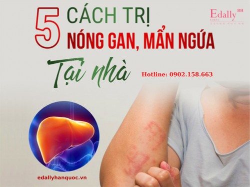 Cách Trị Nóng Gan, Mẩn Ngứa Tại Nhà