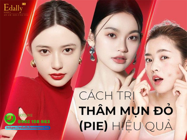 Cách trị thâm mụn đỏ hiệu quả nhất