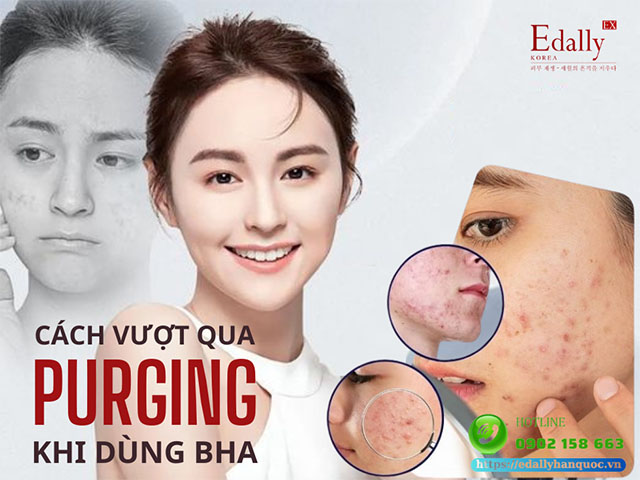 Cách vượt qua giai đoạn đẩy mụn thành công khi dùng BHA một cách êm ái