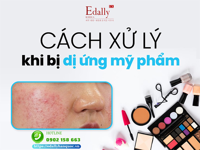 Cách xử lý khi da bị dị ứng mỹ phẩm thế nào?