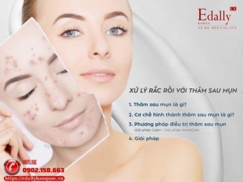 Cách Xử Lý Rắc Rối Với Thâm Sau Mụn