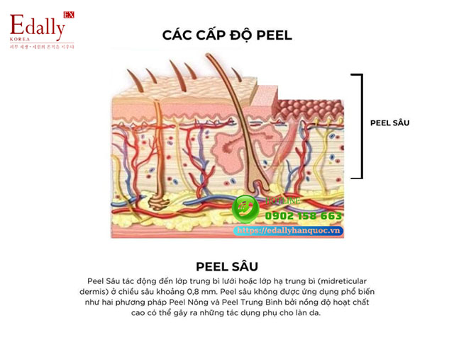 Cấp độ peel da sâu