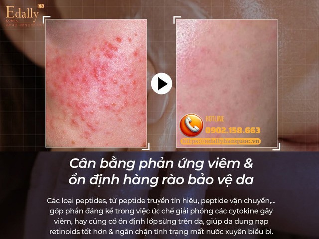 Cặp đôi vàng Peptides + Retinoids giúp cân bằng phản ứng viêm và ổn định hàng rào bảo vệ da