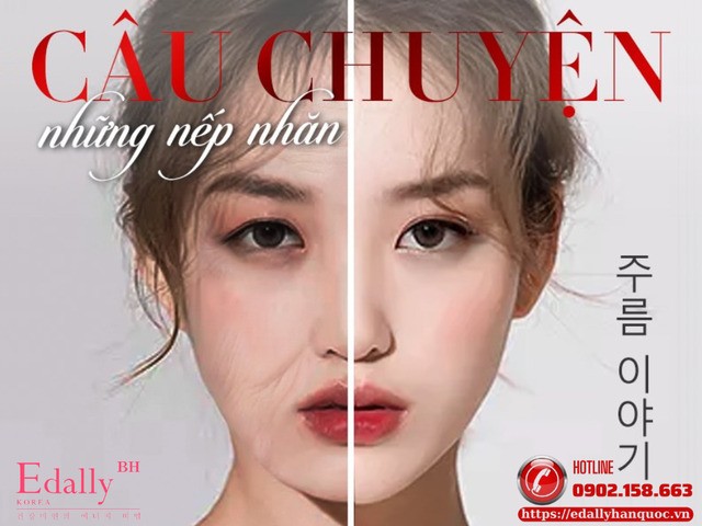 Câu chuyền về nếp nhăn động và nếp nhăn tĩnh