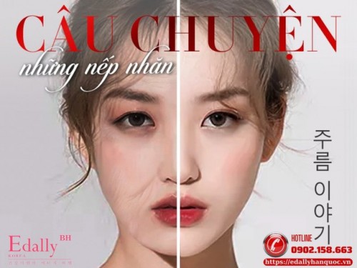 Nếp Nhăn Động Và Nếp Nhăn Tĩnh - Bạn Đang Gặp Loại Nào?