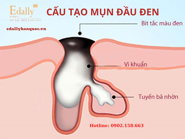 Cấu tạo của mụn đầu đen