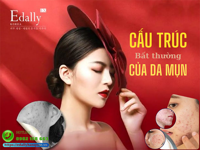 Cấu trúc bất thường của da mụn và cách xử lý an toàn, hiệu quả